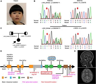 Novel compound heterozygous mutation in STAMBP causes a neurodevelopmental disorder by disrupting cortical proliferation